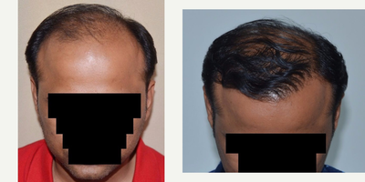 Hair Transplant before and after photo