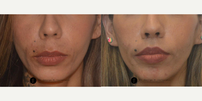 Lip Lift before and after photo