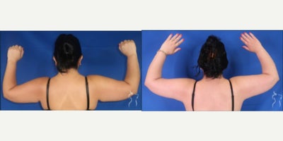 Arm Lift before and after photo