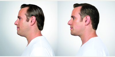 Kybella before and after photo