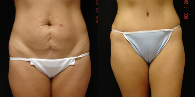 Tummy Tuck before and after photo