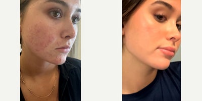 Accutane before and after photo
