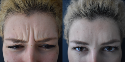 Botox before and after photo