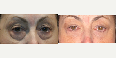 Eyelid Surgery before and after photo