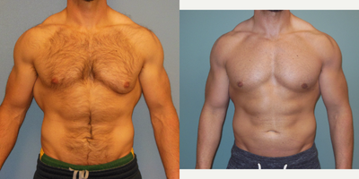 Gynecomastia Surgery before and after photo
