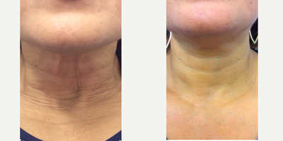 Nonsurgical Neck Lift before and after photo