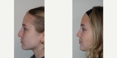 Rhinoplasty before and after photo