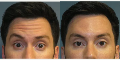 Botox before and after photo
