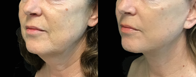 Facelift before and after photo
