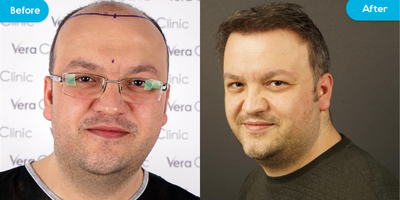 Hair Transplant before and after photo