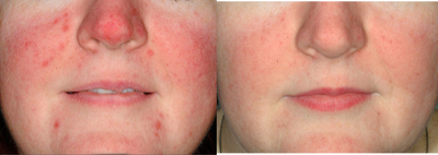 Laser Resurfacing before and after photo