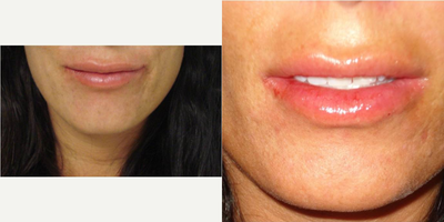 Lip Fillers before and after photo