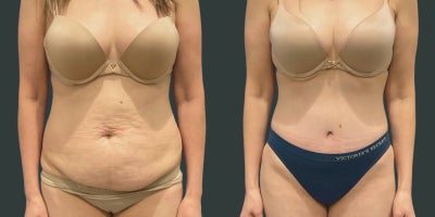 Liposuction before and after photo