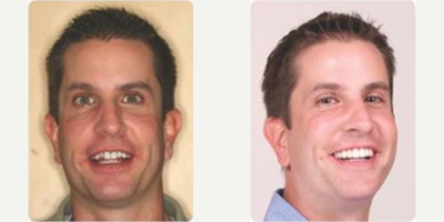 Porcelain Veneers before and after photo