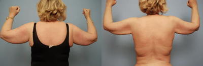 Arm Lift before and after photo