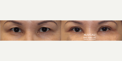 Double Eyelid Surgery before and after photo