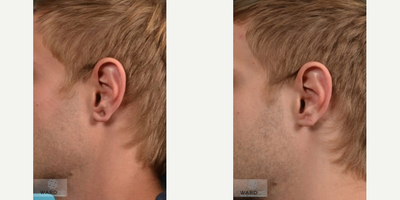 Ear Surgery before and after photo