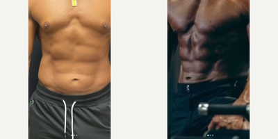 Laser Liposuction before and after photo
