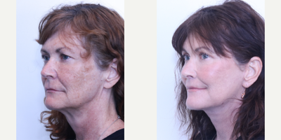 Lip Lift before and after photo
