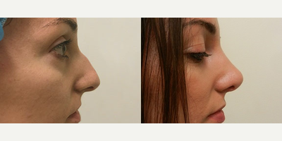 Rhinoplasty before and after photo