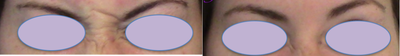 Botox before and after photo