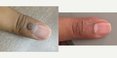 Mole Removal before and after photo