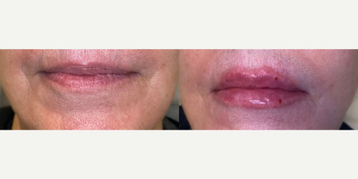 Lip Fillers before and after photo