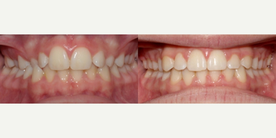 Clear Braces before and after photo