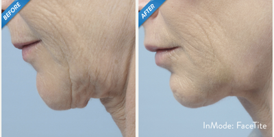 FaceTite before and after photo