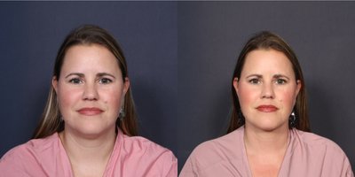 Liposuction before and after photo