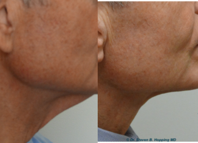 Neck Lift before and after photo