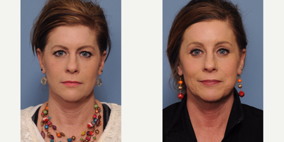 Eyelid Surgery before and after photo