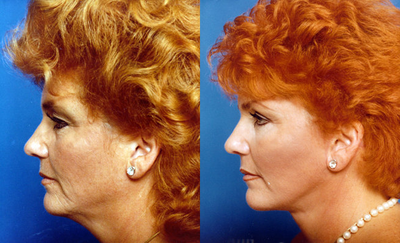 Facial Fat Transfer before and after photo