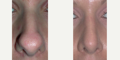 Rhinoplasty before and after photo