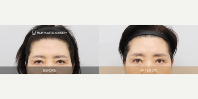 Botox before and after photo