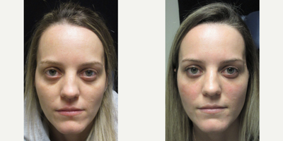 Dermal Fillers before and after photo