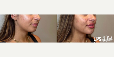 Dermal Fillers before and after photo
