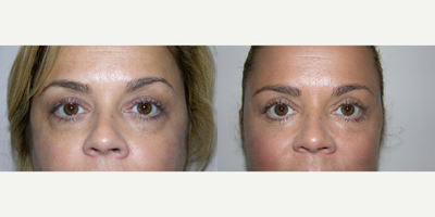 Eyelid Surgery before and after photo