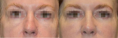 Eyelid Surgery before and after photo