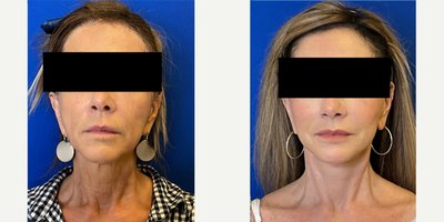 before and after image