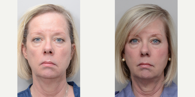 Sculptra before and after photo