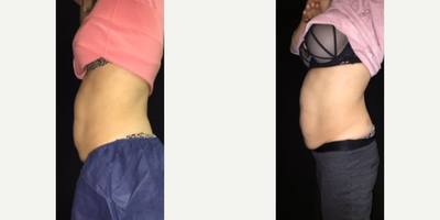 CoolSculpting before and after photo