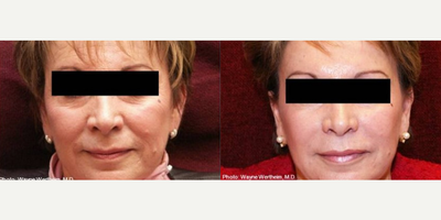 Dermal Fillers before and after photo