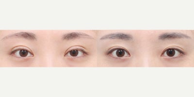 Eyelid Surgery before and after photo