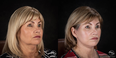 Facelift before and after photo