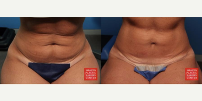 Mini Tummy Tuck before and after photo