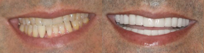 Porcelain Veneers before and after photo