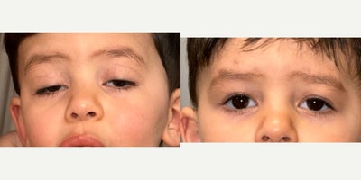 Ptosis Surgery before and after photo