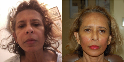 Restylane before and after photo
