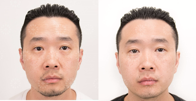 Botox before and after photo